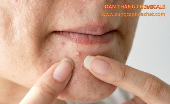 tinh bột khoai tây trị mụn trứng cá